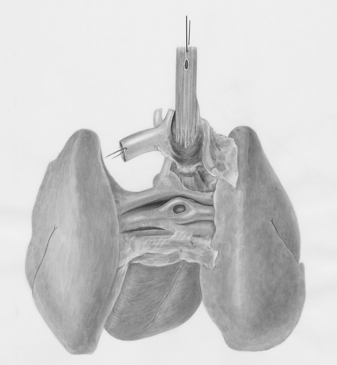 a drawing of a lung with a needle in it